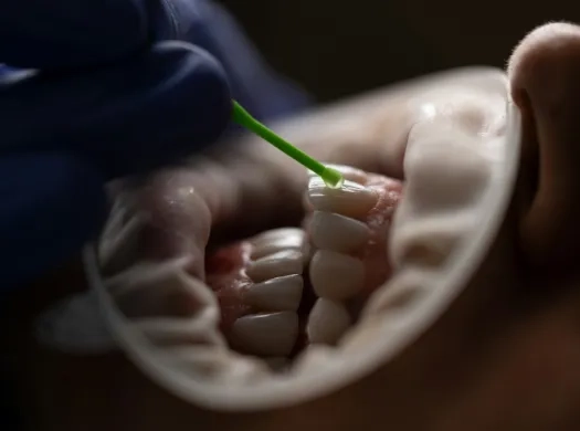 Implantes Dentários