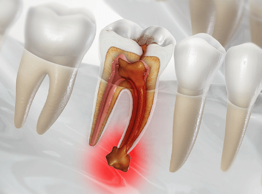 Abscesso dentário