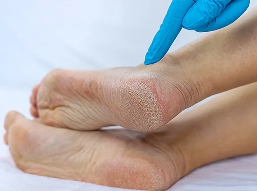 Fissuras nos calcanhares