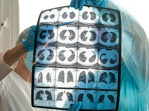 DPOC (bronquite crónica e enfisema pulmonar)