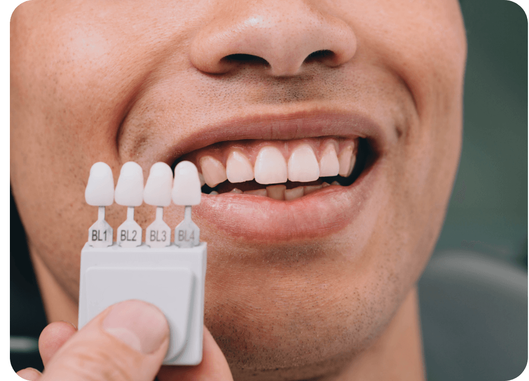 Branqueamento Dentário