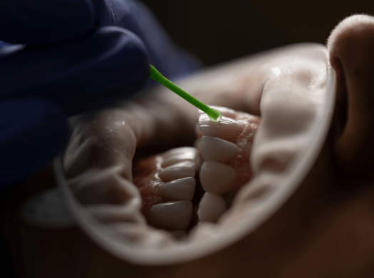Implantes Dentários