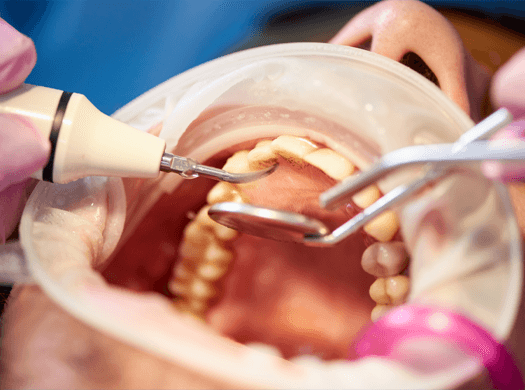 Trauma dentário