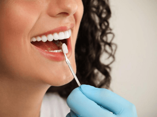 Facetas Dentárias